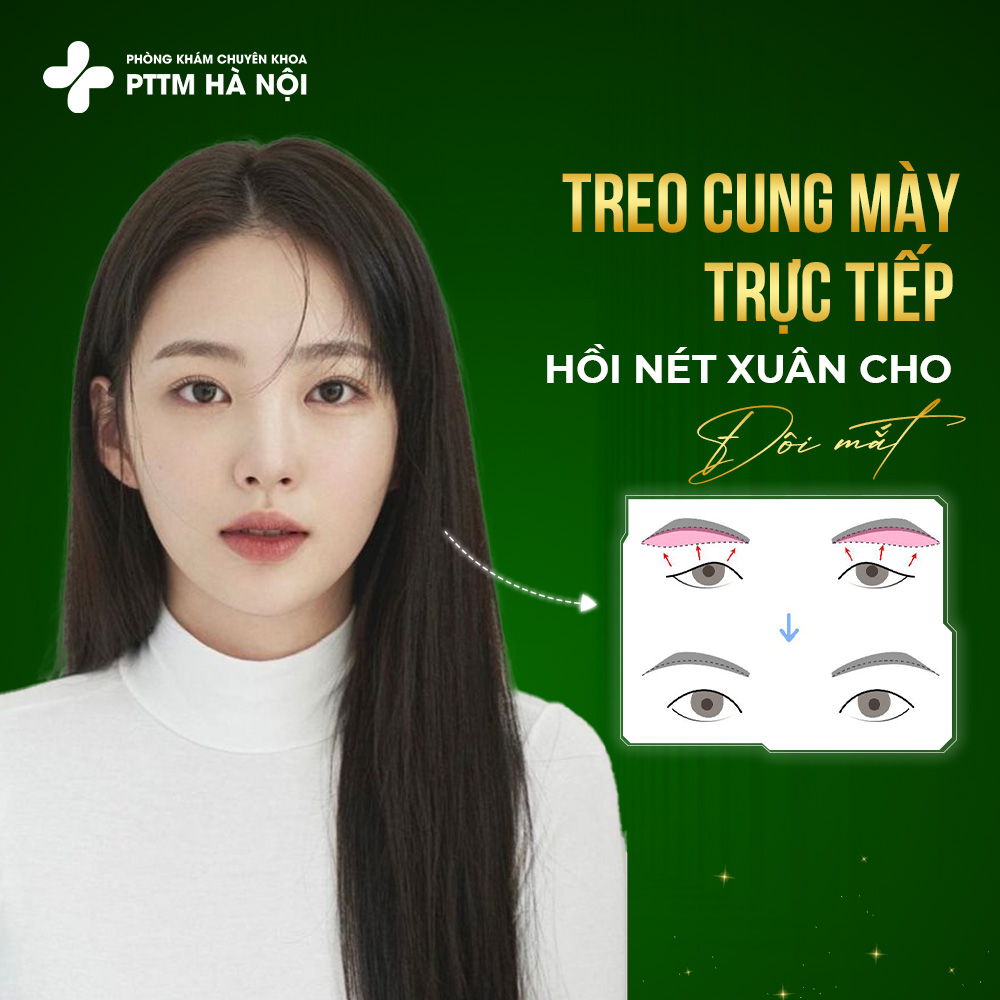 Nâng Cung Mày Là Gì? Ai Nên Thực Hiện?