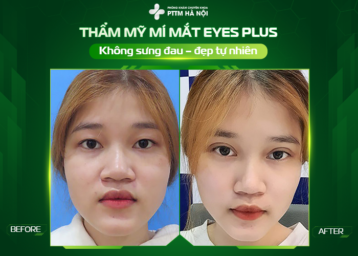 Góc nghiêng trước và sau cắt mí tự nhiên Hình ảnh góc nghiêng khách hàng sau khi cắt mí tại Phòng khám chuyên khoa phẫu thuật thẩm mỹ Hà Nội! Đường mí hài hòa, tự nhiên, không lộ dấu thẩm mỹ.